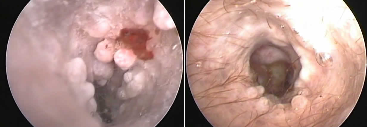 Polypid Ceruminous Gland Hyperplasia before and after treatment