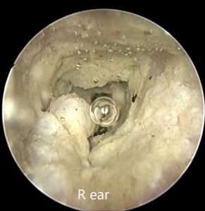 Severe polypoid hyperplasia in dog ear